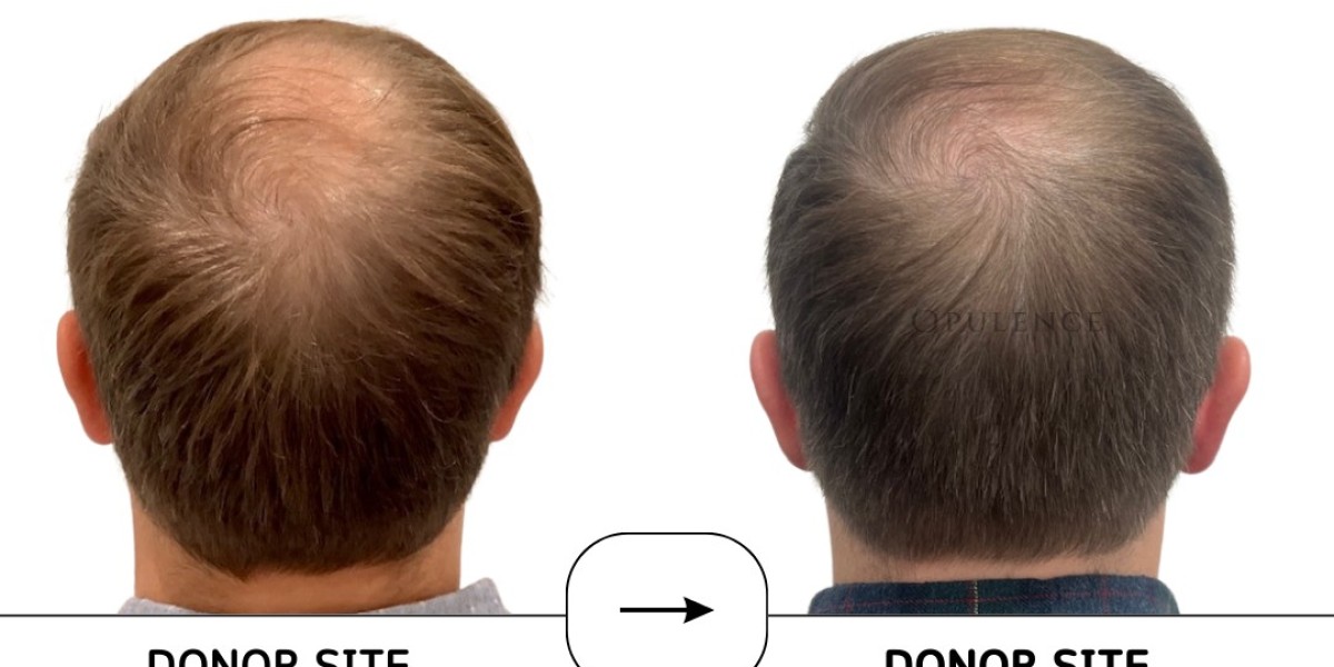 Hair Restoration in Chicago: The Ultimate Hair Loss Solution by Opulence Chicago LLC