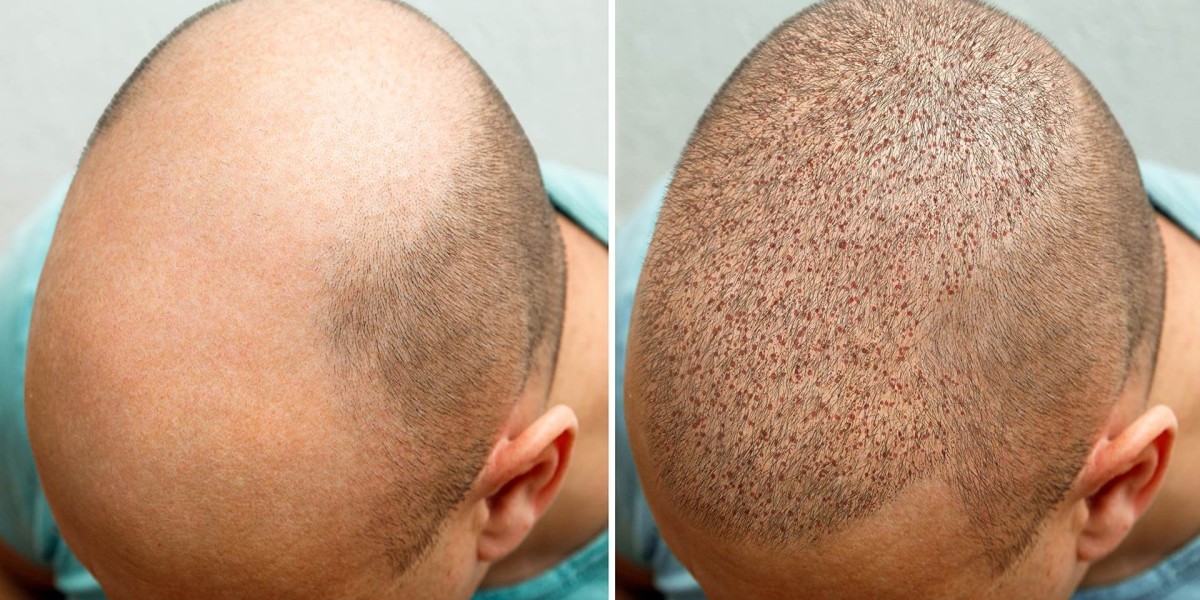 Hair Transplant in Malviya Nagar: Transform Your Look at AISHH Clinic