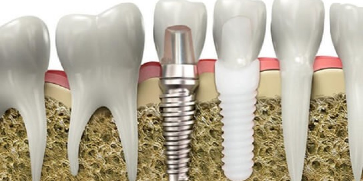 How Dental Implants Improve Oral Health and Confidence