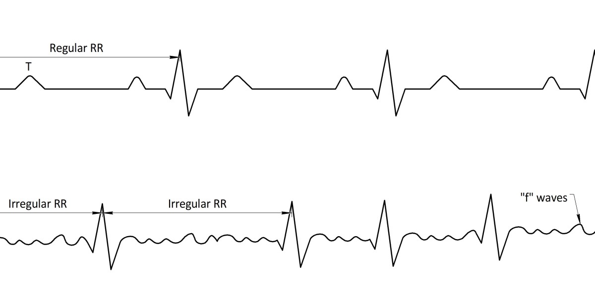 Atrial Fibrillation (Afib) Market: Recent Developments Shaping Diagnosis and Treatment