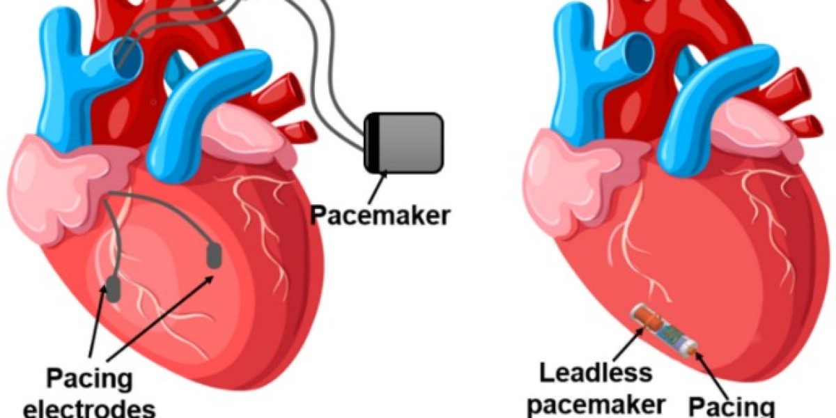 Chennai's top cardiologist for leadless pacemaker implantation and care is Dr. Deep Chandh Raja