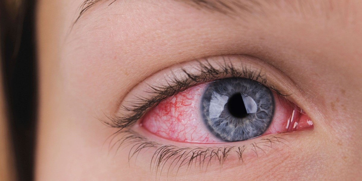 Dry Eye Syndrome Market: The Evolving Scope and New Horizons