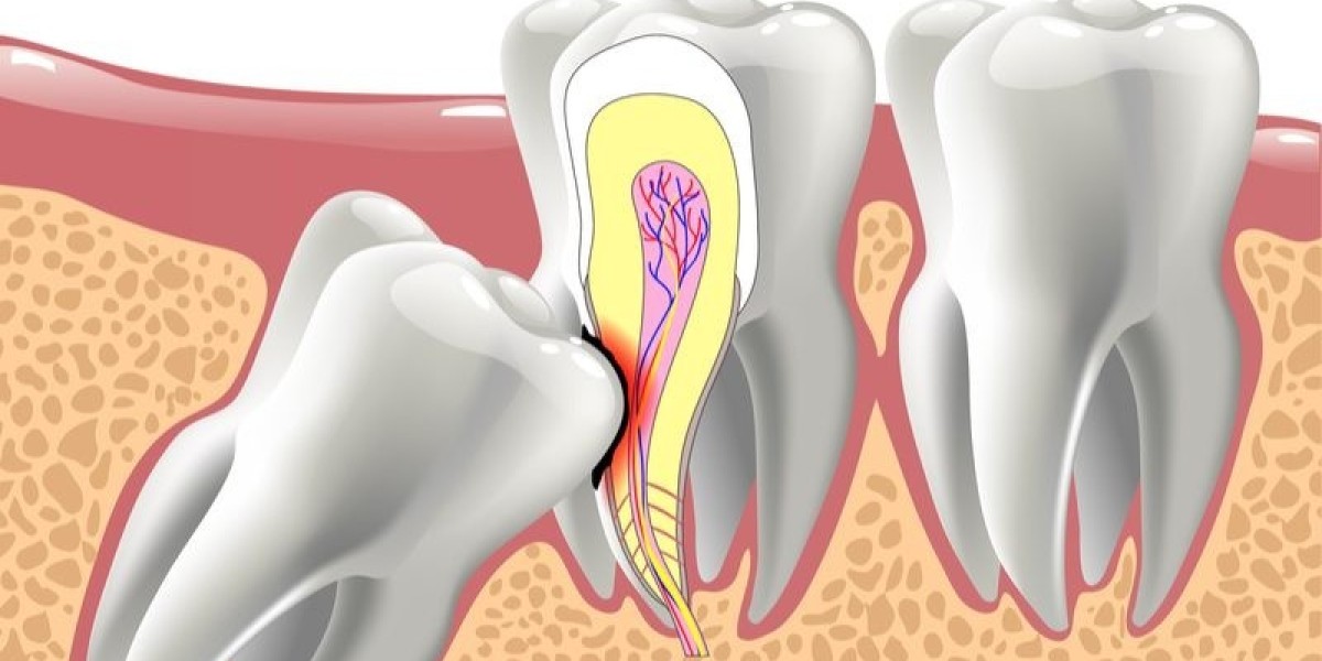 Essential Recovery Tips for a Quick Wisdom Tooth Extraction Healing