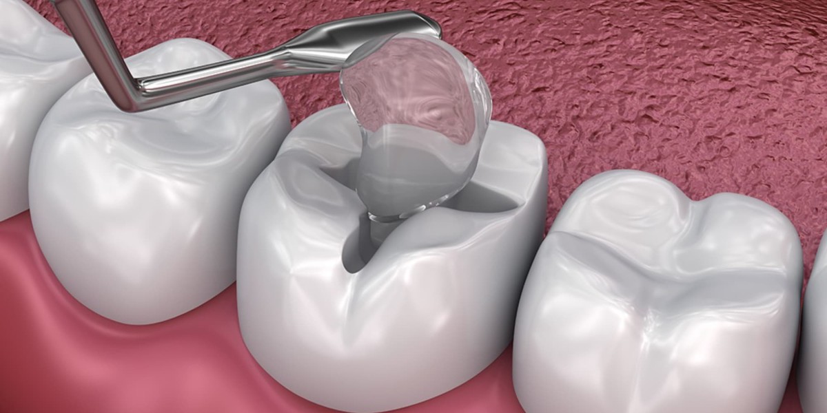 Dental Sealants Market: A Focus on Innovative Developments