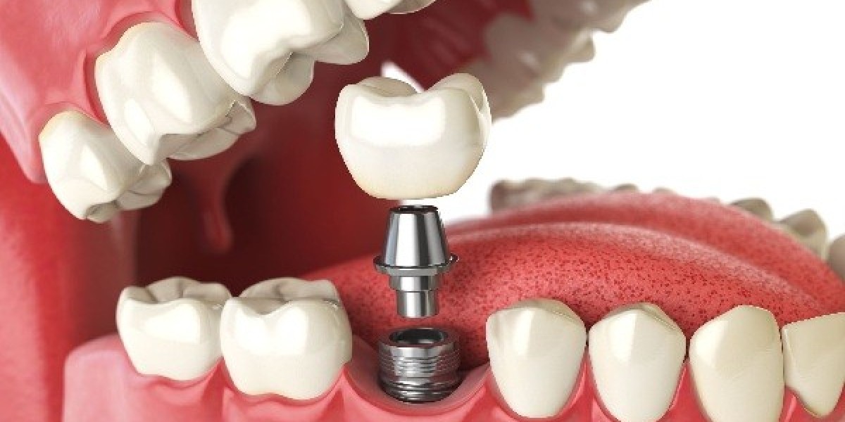 Are Dental Implants Right for You? Key Considerations