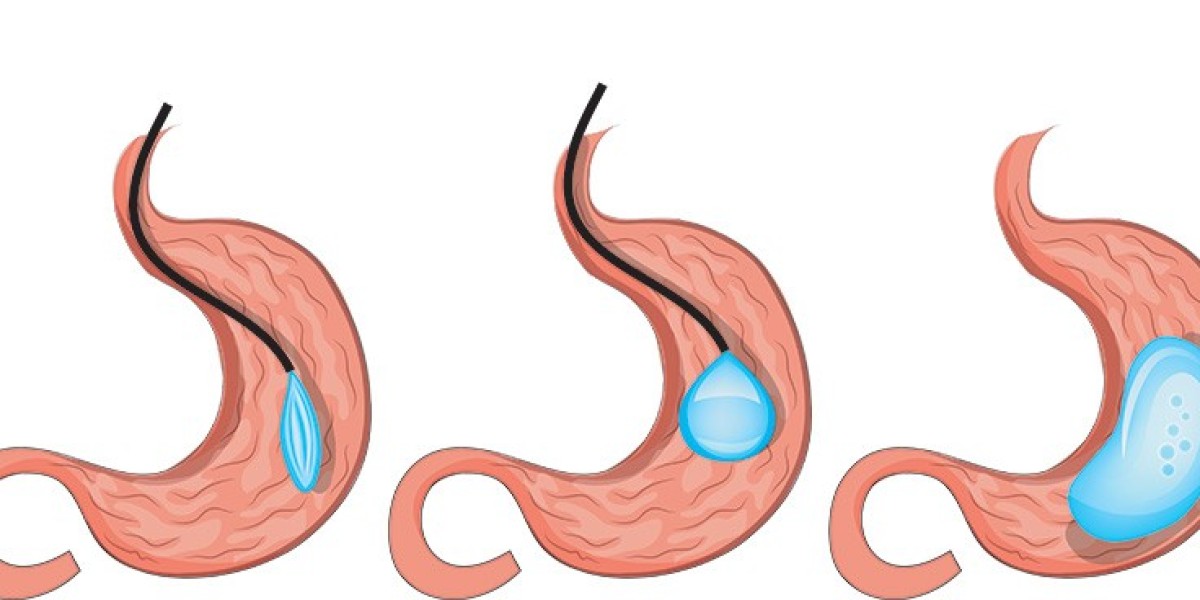 Intragastric Balloon Market Key Players & Forecast Report to 2032