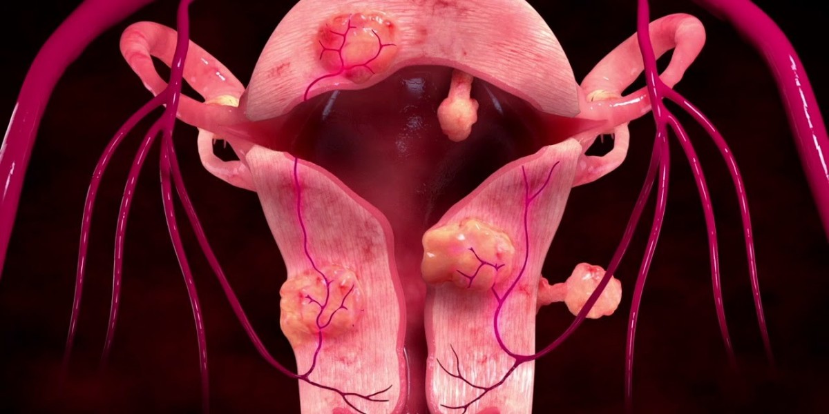 Uterine Fibroid Treatment Market Expansion: Key Growth Drivers, Market Segmentation, and Regional Opportunities