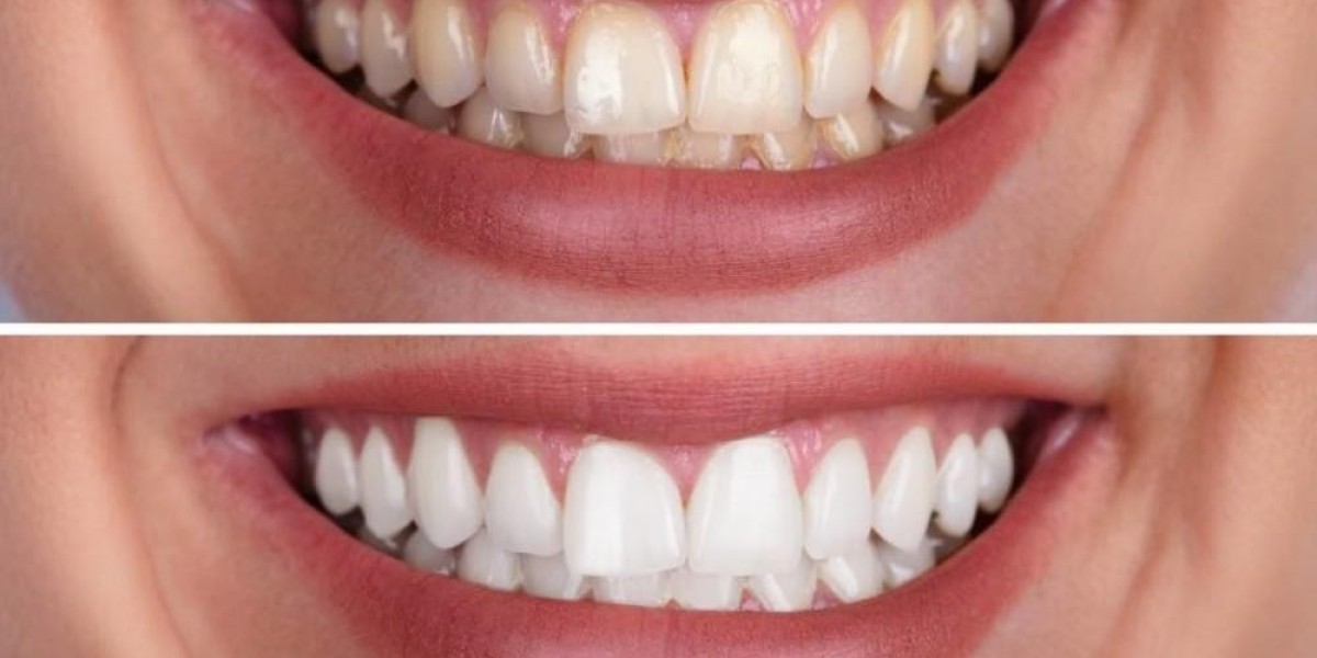 The Long-Term Effects of Seeing a Teeth Whitening Dentist