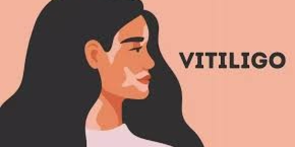 Whole Body Vitiligo Treatment