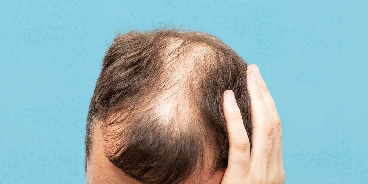 Canada Androgenetic Alopecia Market: Emerging Treatments, Growth Drivers, and Future Opportunities 2033