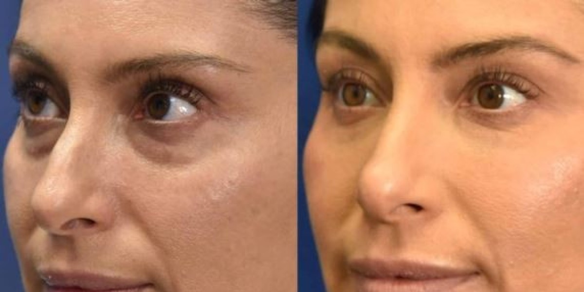 Are Tear Trough Fillers Right for You?