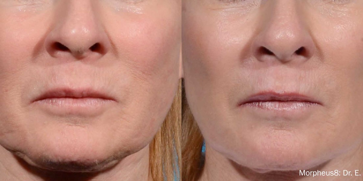 How Morpheus 8 Redefines Skin Tightening for a Youthful Glow