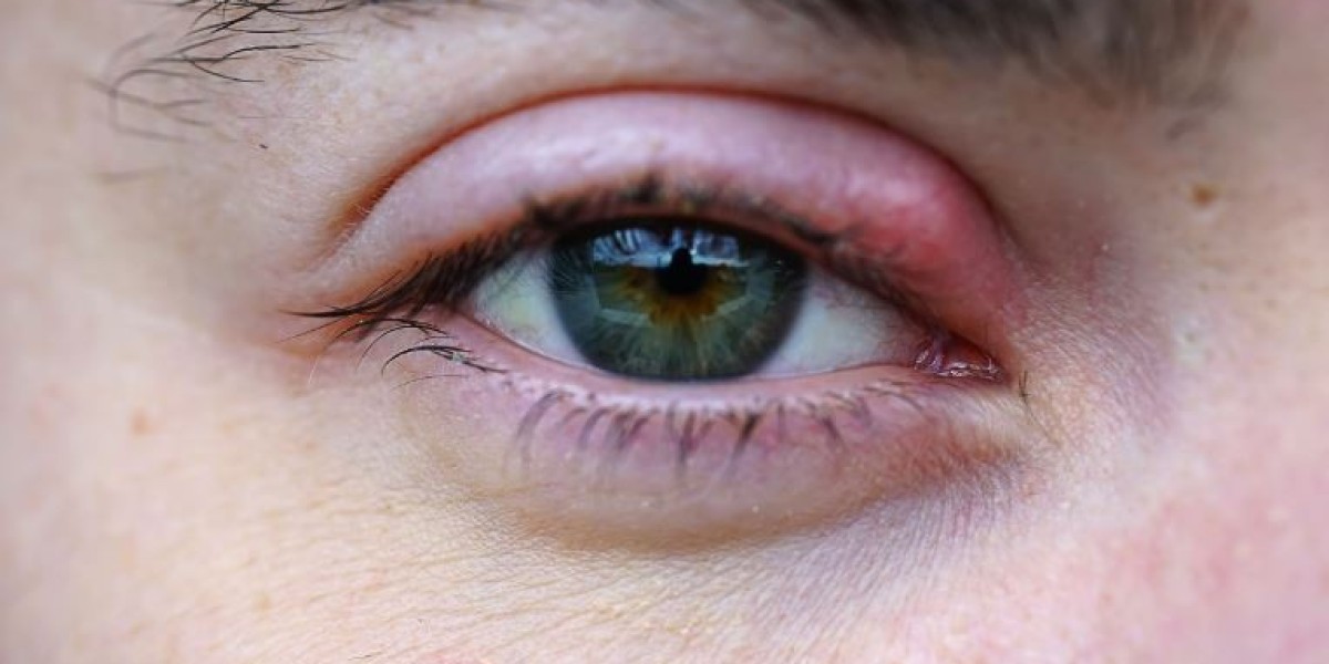 Chalazion NHS vs. Stye: Knowing the Difference