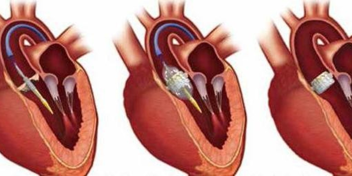 Prosthetic Heart Valves Market: Competitive Analysis, Growth Opportunities, and Market Dynamics