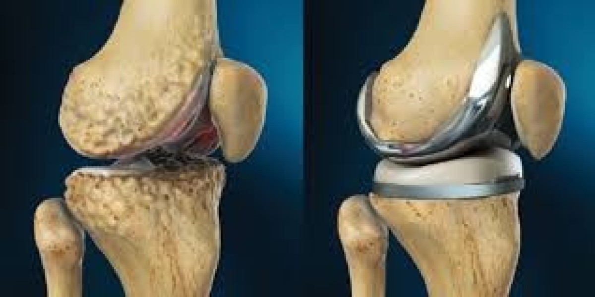 Causes of Pain After Knee Replacement Surgery