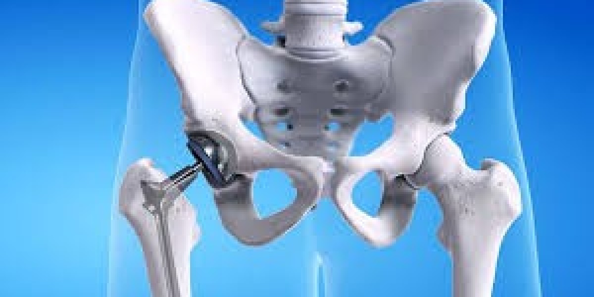 How Long Does a Hip Replacement Last