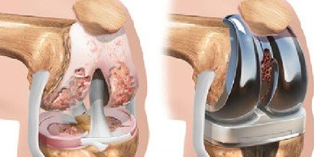 Causes of Pain After Knee Replacement Surgery