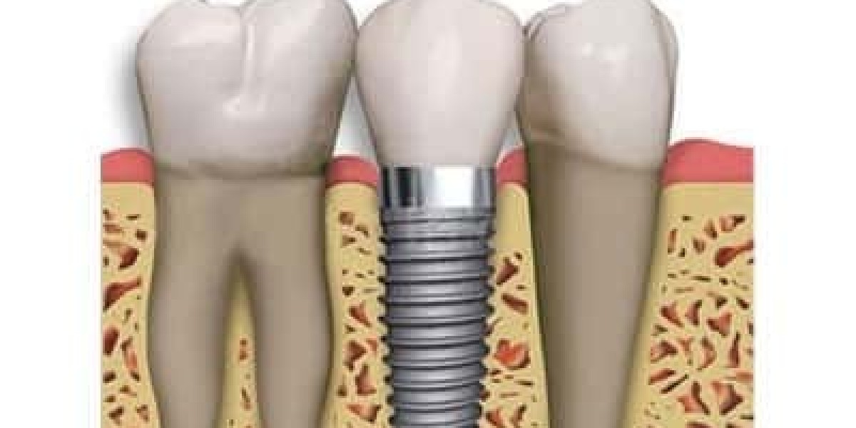 Dental Implants: A Comprehensive Guide to Restoring Your Smile