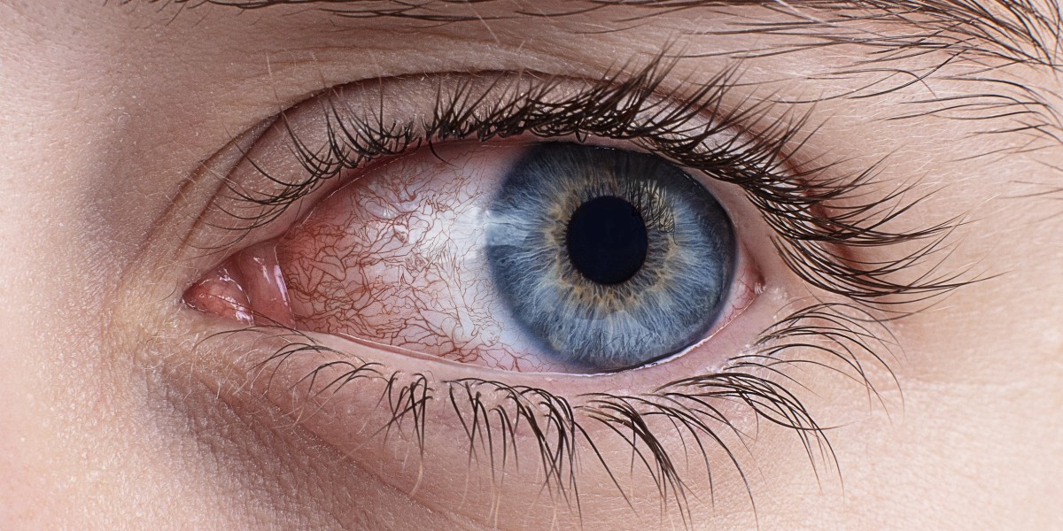 Dry Eye Syndrome Market: Recent Developments in Treatment and Diagnosis