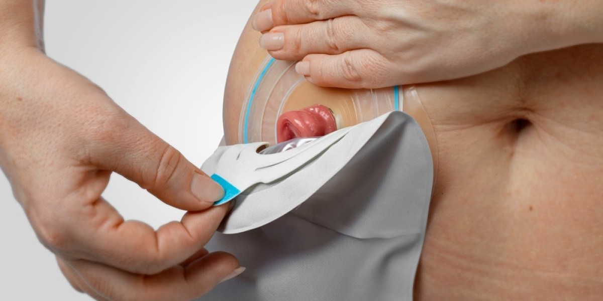 Ostomy Devices Market: Insights into Innovations and Market Trends