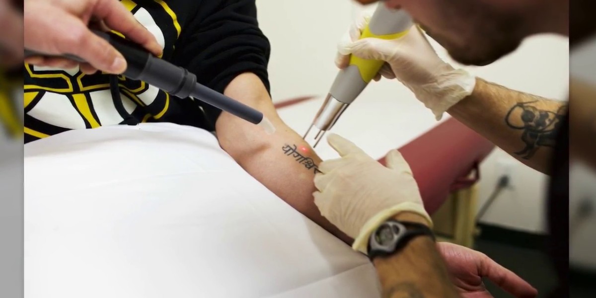 How Can You Minimize Pain and Discomfort During Tattoo Removal?