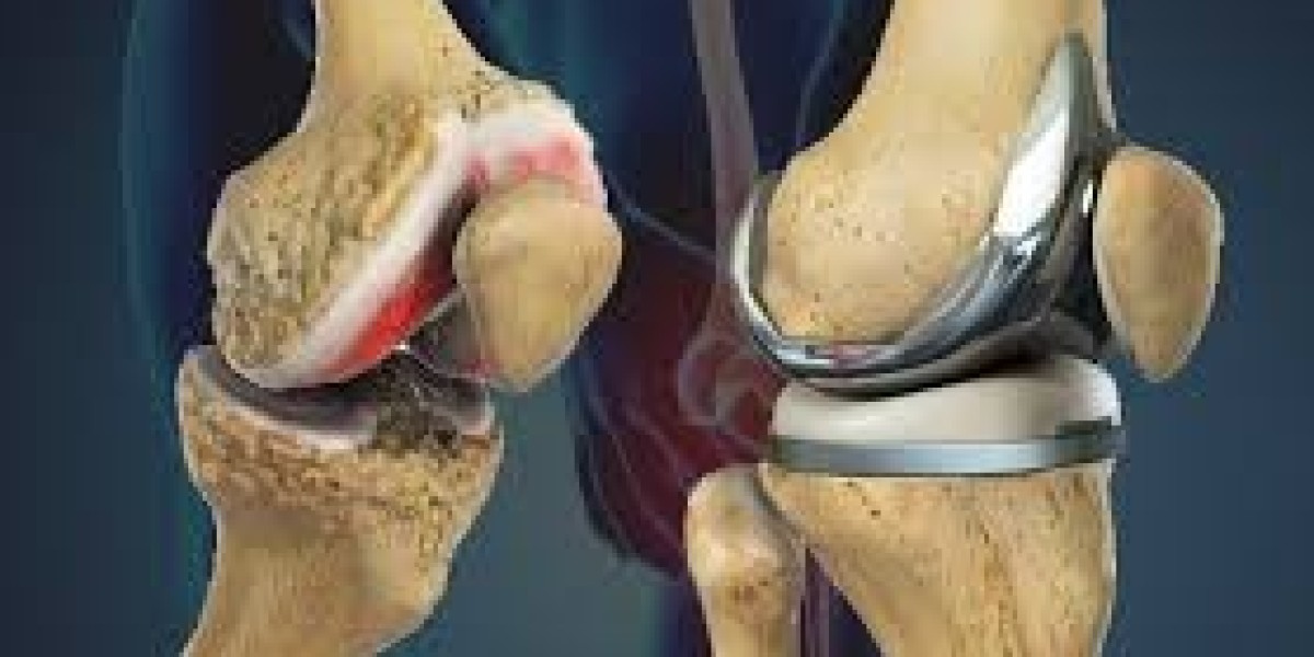 Top 5 Mistakes After Knee Replacement Surgery