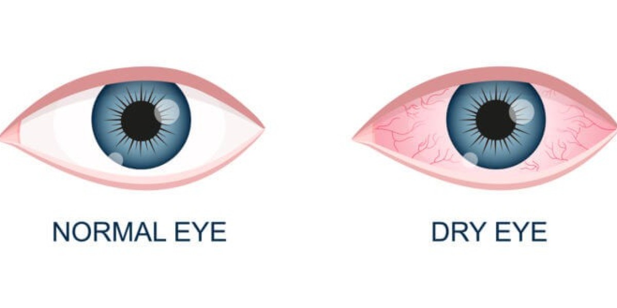 Dry Eye Syndrome Market Dynamics: How Innovations and Consumer Awareness Are Fueling Global Market Growth