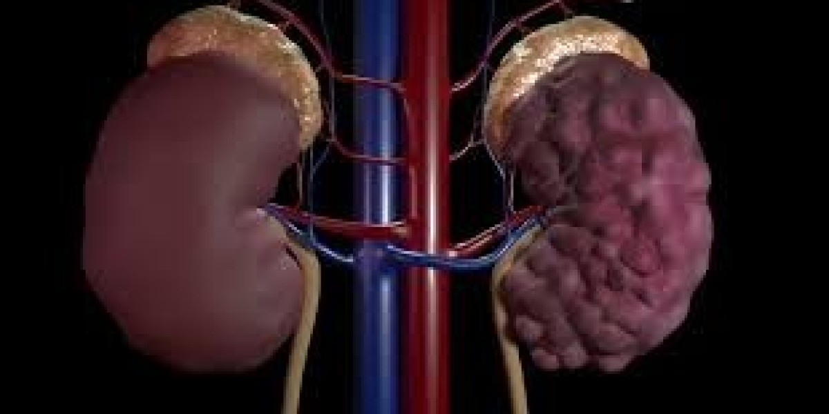 Polycystic Kidney Disease Market Size: Growth, Trends, and Future Outlook