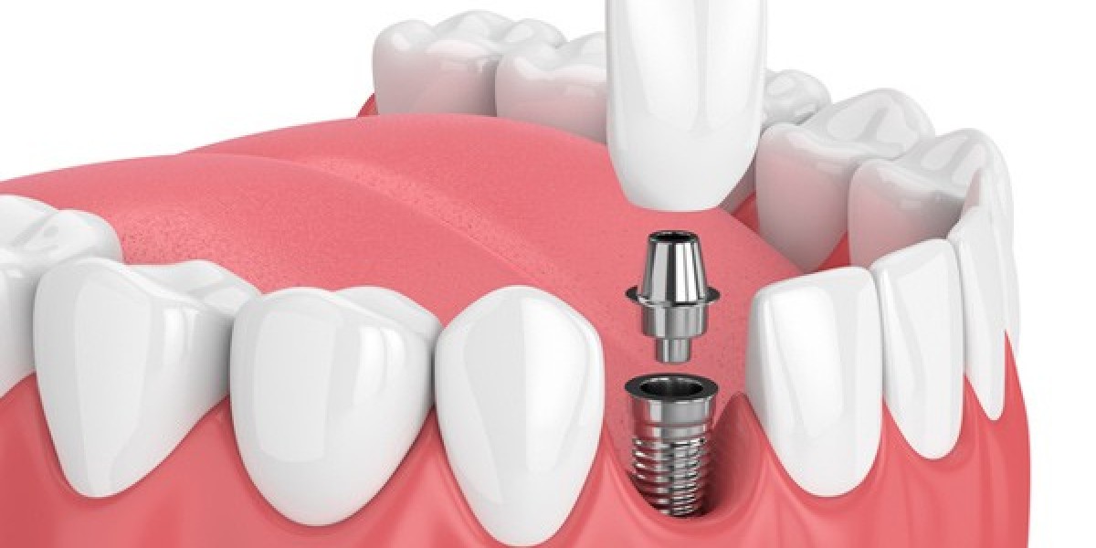 Dental Implants in Dubai: Why They Are the Best Solution for Missing Teeth