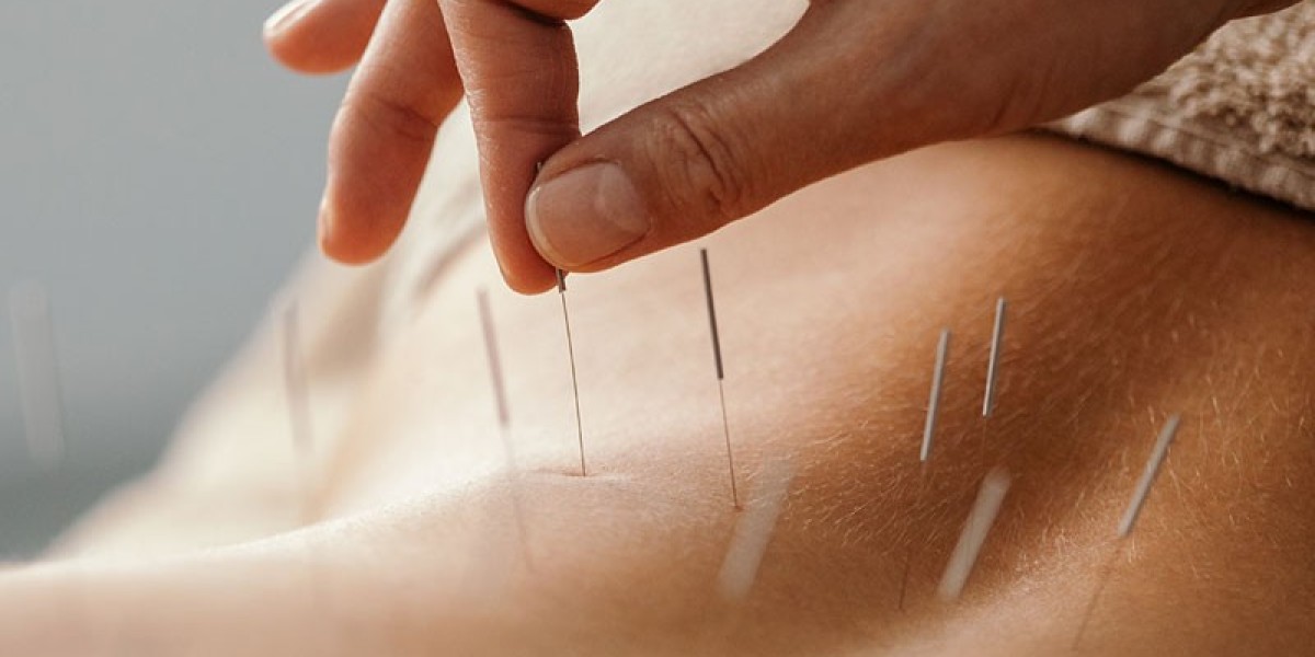 Acupuncture for Digestive Issues: A Natural Remedy for Gut Health