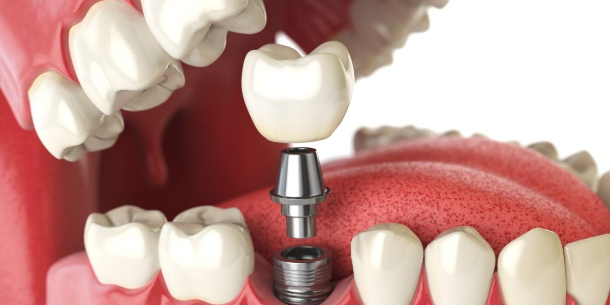 Rediscover Your Smile: How Dental Implants Transform Senior Oral Health