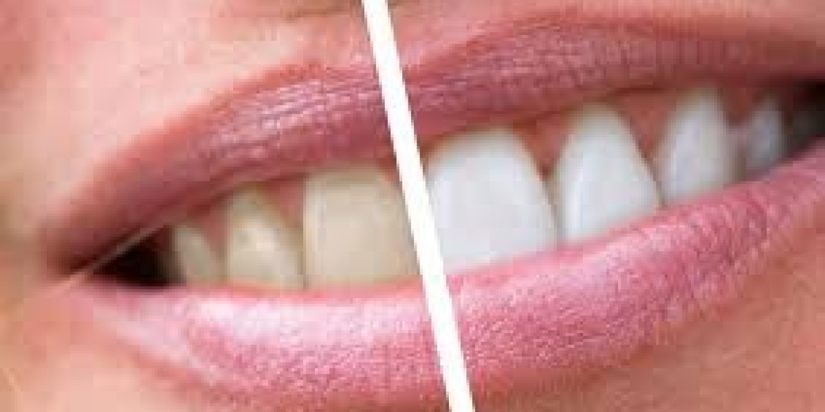 Best Teeth Whitening Dubai – Get a Brighter Smile Today!