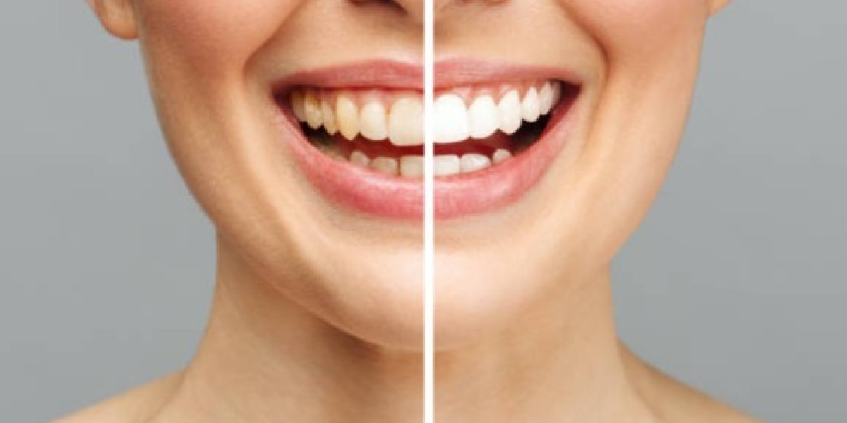 What Are the Most Popular Smile Design Treatments?