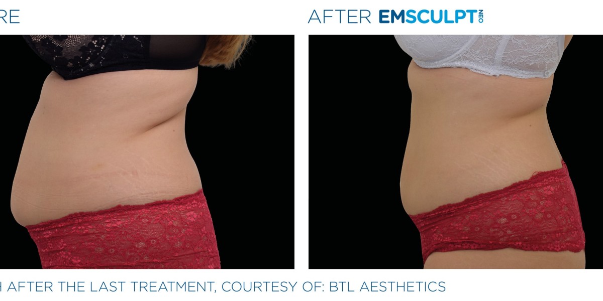 EmSculpt Neo West Loop: The Ultimate Body Sculpting Solution