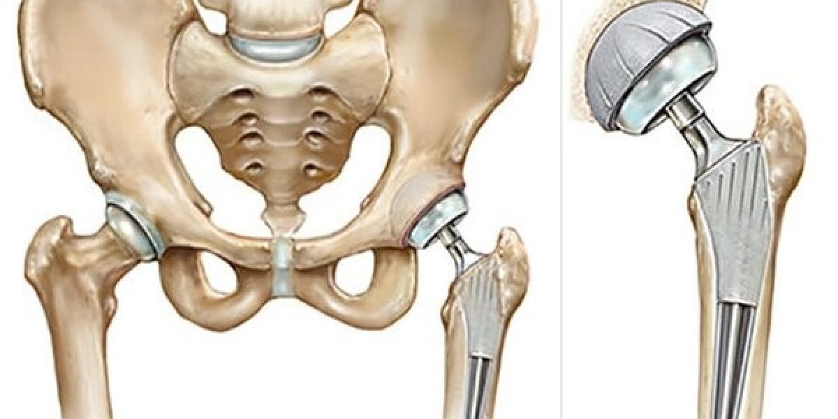 Joint Replacement in Rajsthan