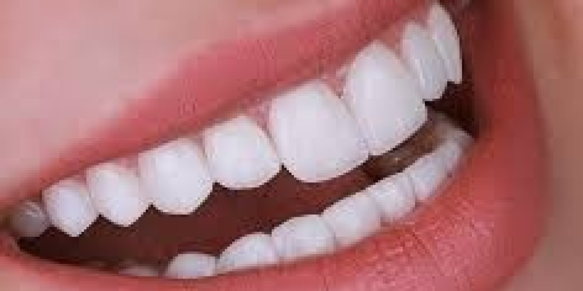 Veneers Dubai: The Perfect Smile Solution