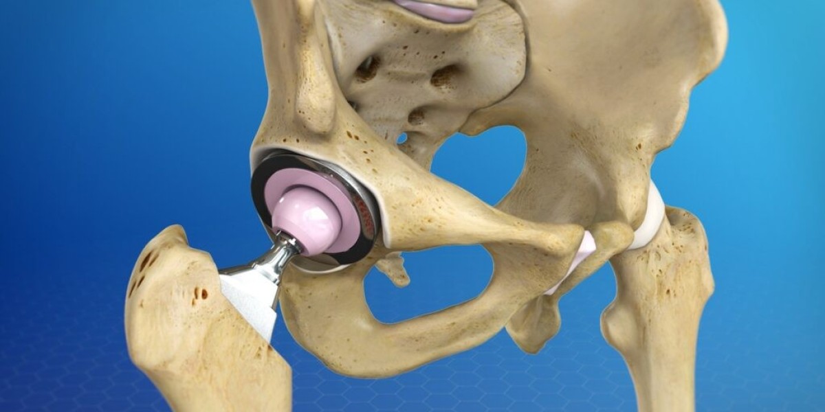 What I Wish I Knew Before Hip Replacement Surgery