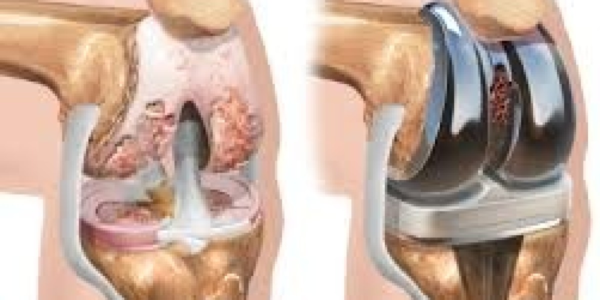 Exploring Knee Replacement Surgery: Risks, Benefits, and What to Expect